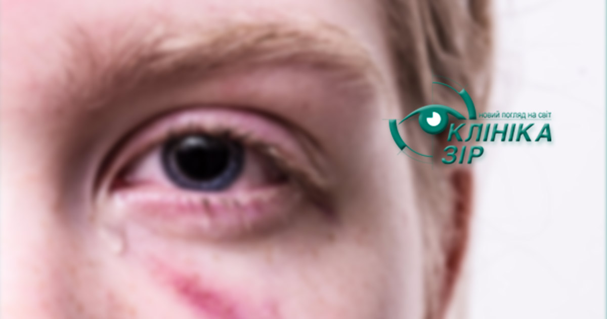 Травма ока: інструкція з першої допомоги та помилки