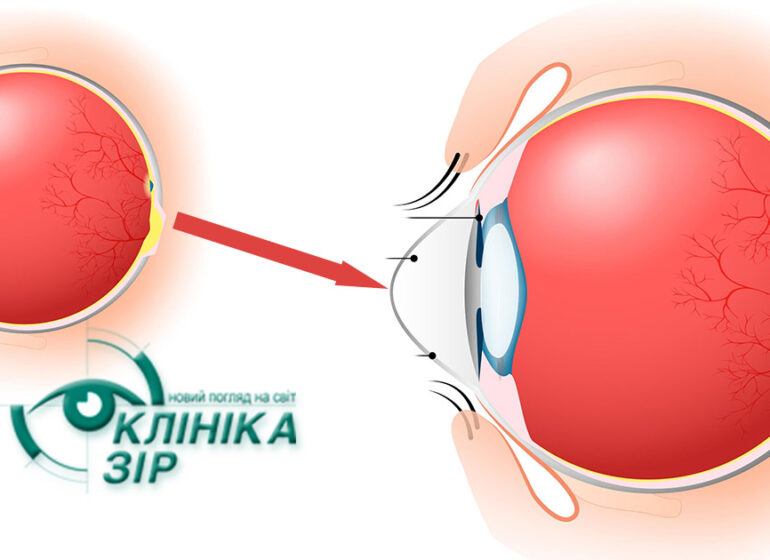 Кератоконус: чому зір стрімко падає, а окуляри перестають допомагати?
