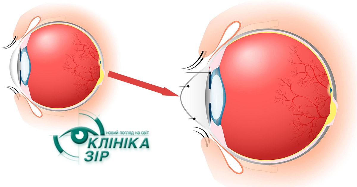 Кератоконус: чому зір стрімко падає, а окуляри перестають допомагати?