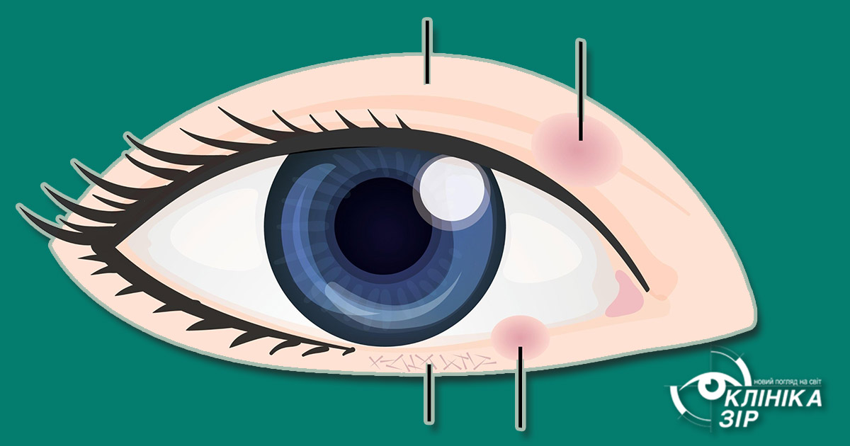 Ячмінь чи халязіон?