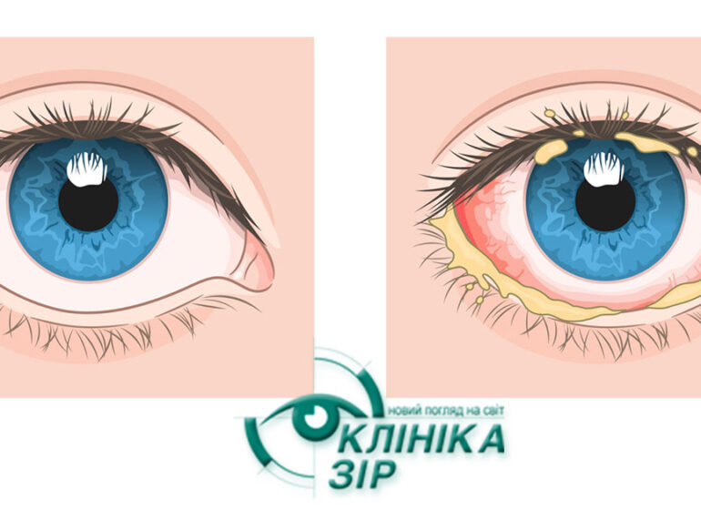 Види кон'юнктивіту: симптоми та правильне лікування