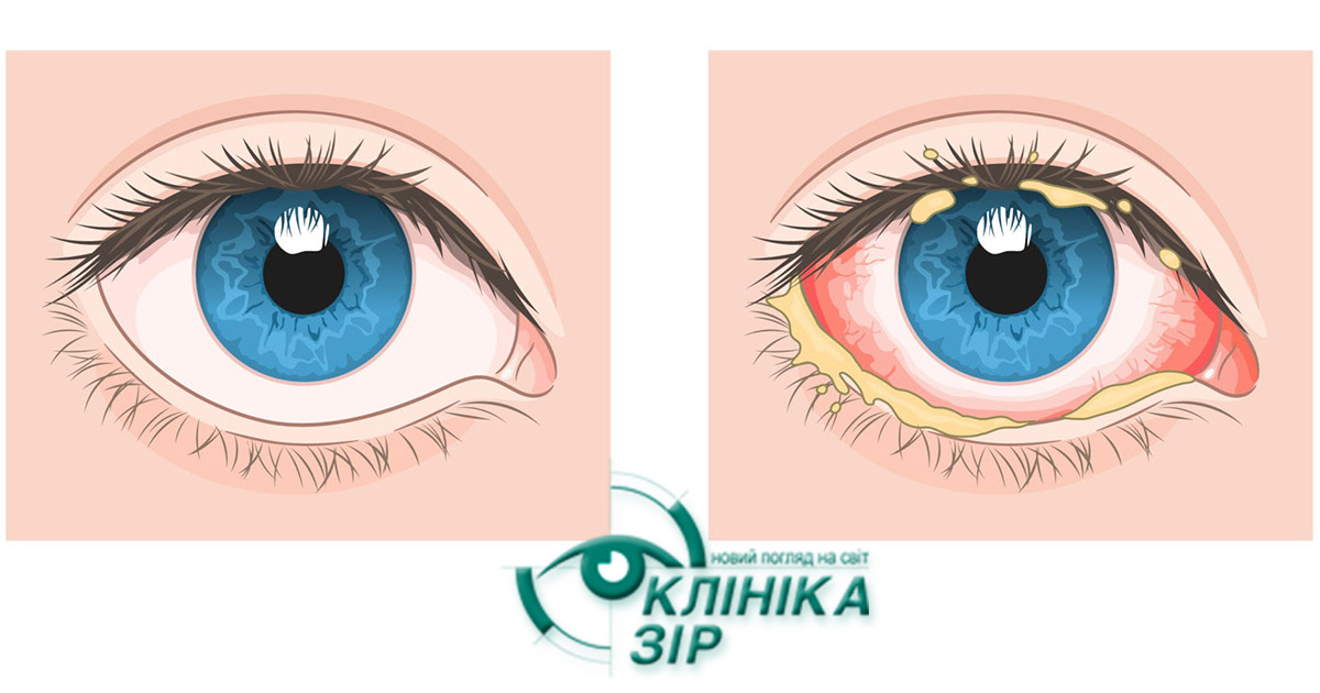 Види кон'юнктивіту: симптоми та правильне лікування