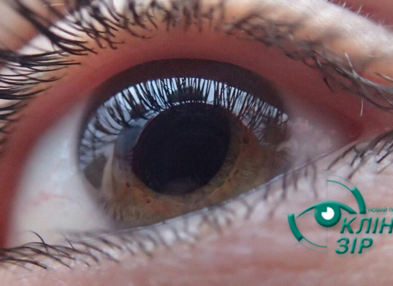 Лазерне зміцнення сітківки