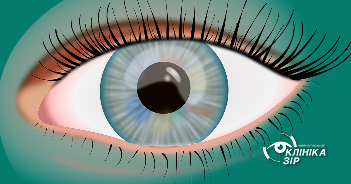 Косоокість у дитини