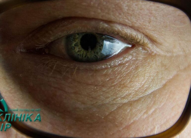 ячмінь чи халязіон