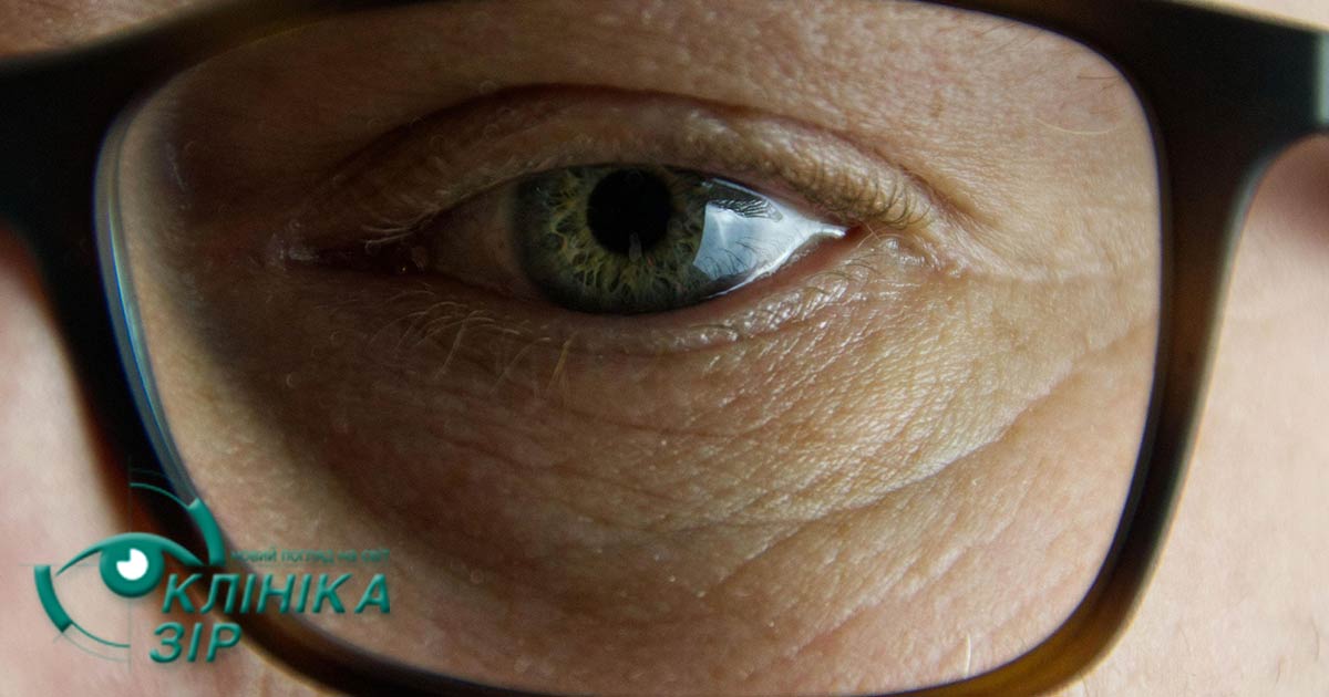 ячмінь чи халязіон